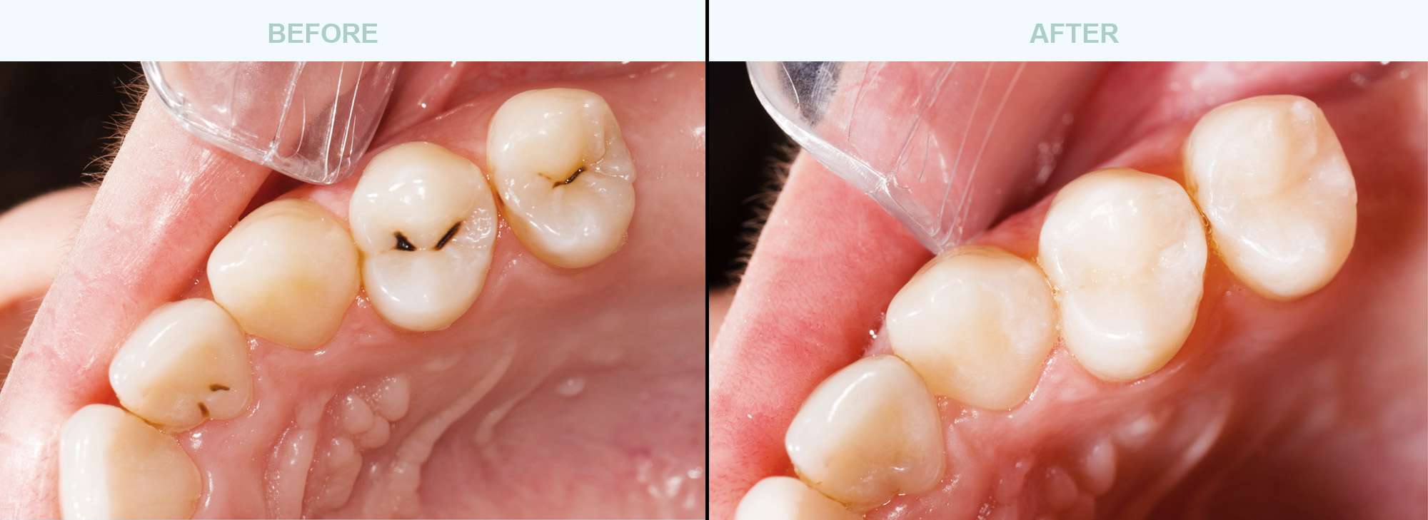 Dental-Fillings-before-after