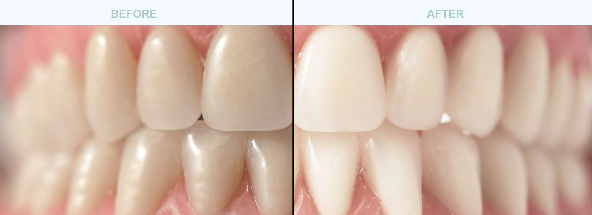 Teeth-Whitening-before-after